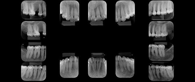 Periapical Boca Toda